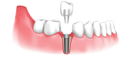 Biological Implants Market Set for Rapid Growth, Expected to Reach USD 268 Billion by 2030