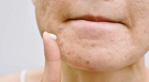 Breaking New Ground in Acne Treatment: Spotlight on the Top 5 Players Shaping the Market
