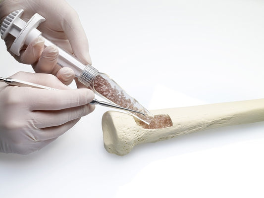 Bone Grafts and Substitutes Market Set for Strong Growth, Projected to Reach USD 5 Billion by 2030