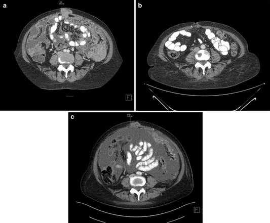 Alpelisib Market Poised for Strong Growth, Driven by Rising Cancer Incidences and FDA Approvals