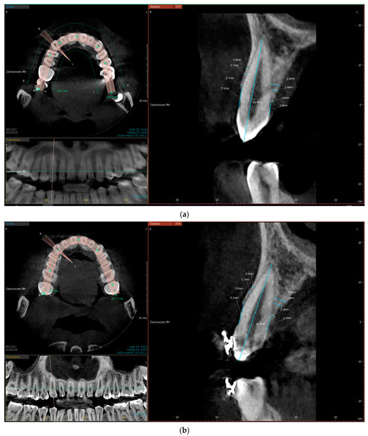 Germany Cone-Beam Computed Tomography (CBCT) Systems Market is Predicted to Reach USD 208 Million with a CAGR of 11% by 2030