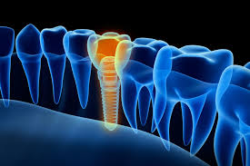 Osseointegration Implants Market to Reach USD 14 Billion by 2030, Growing at a CAGR of 8%
