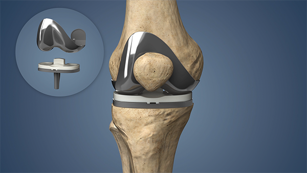 Knee Implants Market Projected to Reach USD 17 Billion by 2030, Growing at a CAGR of 6%