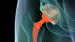 Orthopedic Implants Market to Reach USD 81 Billion by 2030, Fueled by Rising Geriatric Population and Technological Advancements