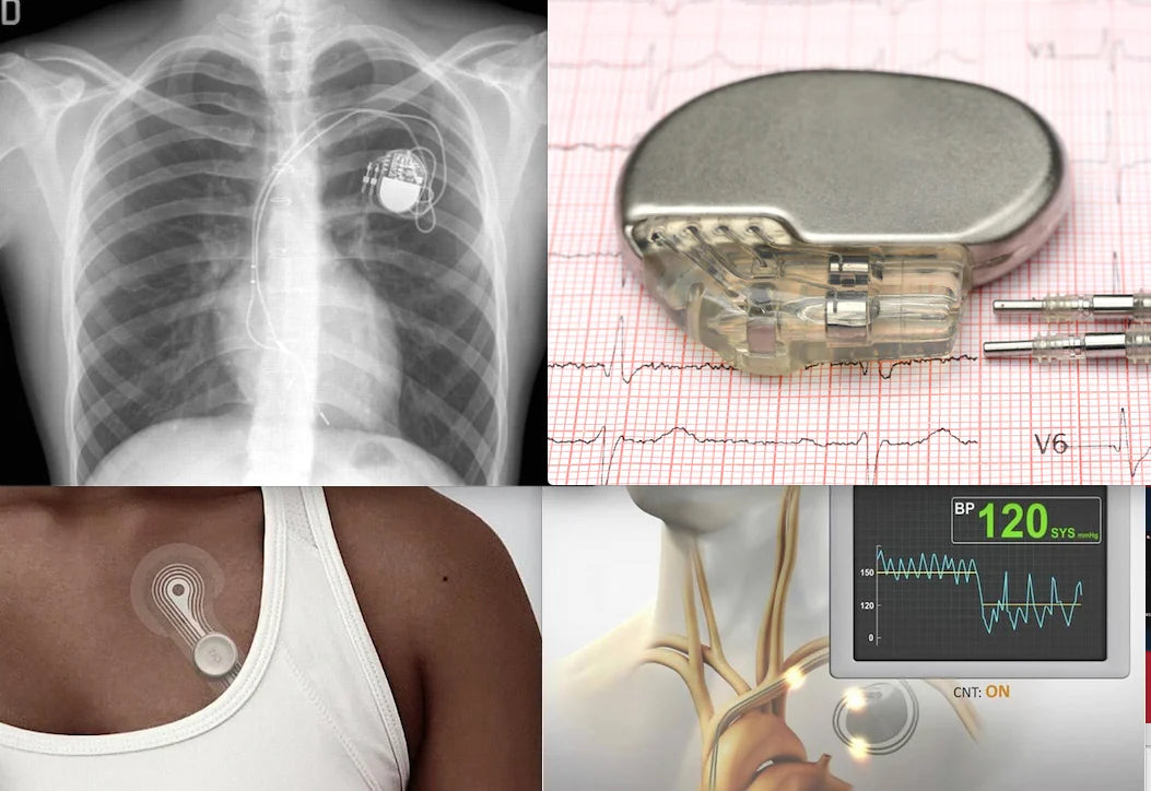 Implantable Cardiac Monitor Market Set to Reach USD 1 Billion by 2030, Driven by Increasing Cardiac Arrhythmias and Technological Advancements