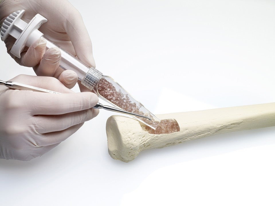 Bone Grafts and Substitutes Market Set for Strong Growth, Projected to Reach USD 5 Billion by 2030