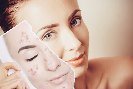 From Breakouts to Breakthroughs: The Future of Acne Treatment