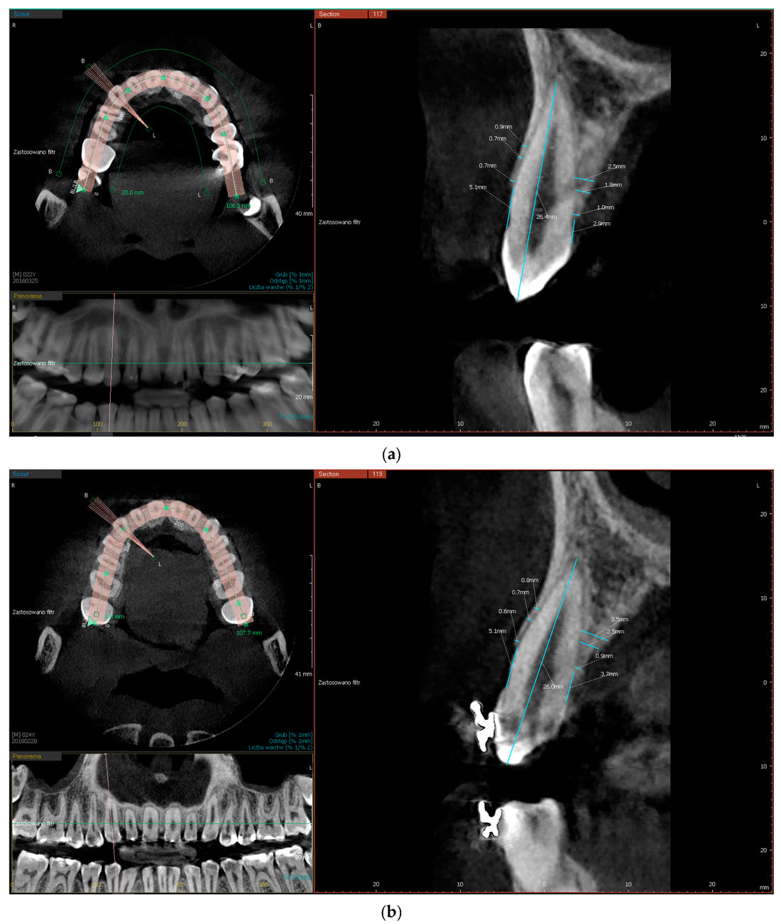 Germany Cone-Beam Computed Tomography (CBCT) Systems Market is Predicted to Reach USD 208 Million with a CAGR of 11% by 2030