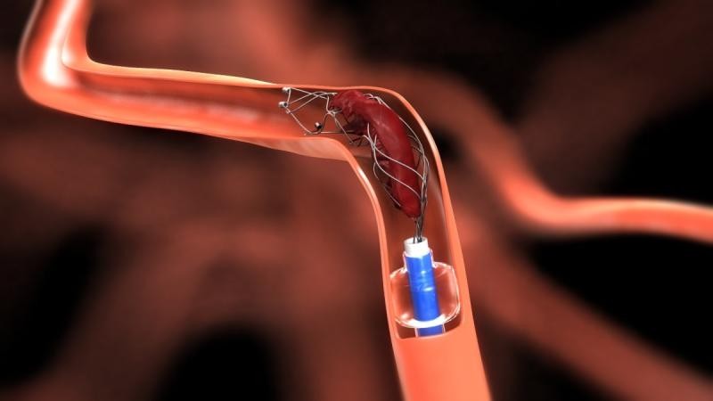 Neurovascular Device Market Poised for Significant Growth, Expected to Reach USD 6 Billion by 2030