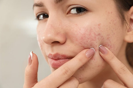 Taiwan Professional Acne Medication Market Set for Robust Growth with a Projected CAGR of 12% by 2030