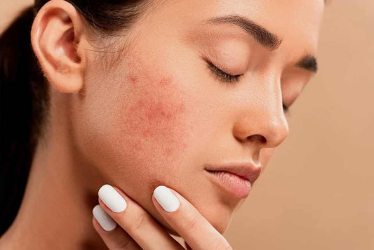 Mexico Professional Acne Medication Market to Reach USD 182 Million by 2030, Growing at a Robust CAGR of 10%