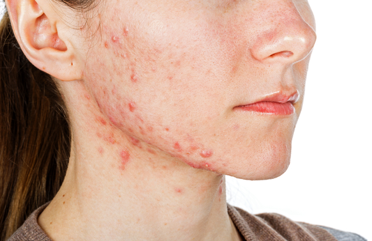 The U.S. Professional Acne Medication Market to Reach USD 1624 Million by 2030 with a CAGR of 4%
