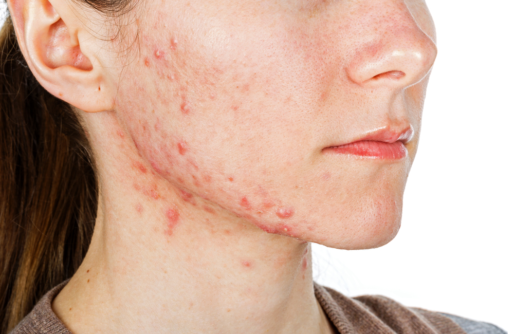 Vietnam Professional Acne Medication Market Set to Grow at a Robust CAGR of 11% from 2024 to 2030