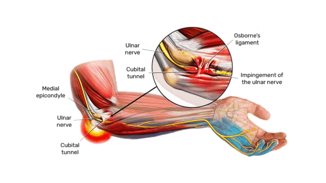 Global Cubital Tunnel Syndrome Market Overview: Strategies for 2030