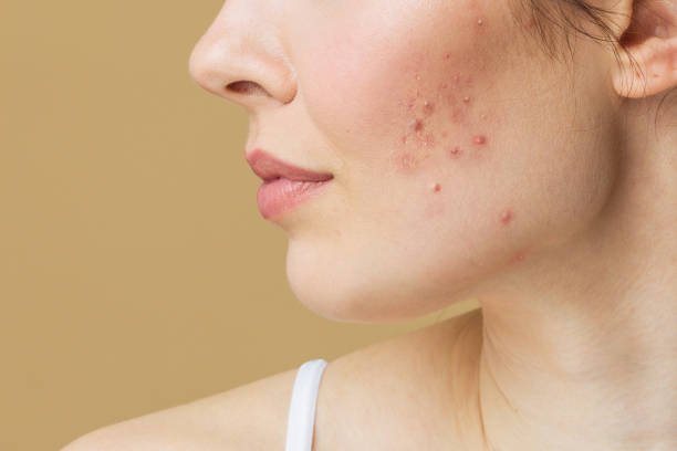 Acne Medication Market Set to Grow to USD 14 Billion by 2030, Driven by Rising Acne Prevalence and Lifestyle Changes