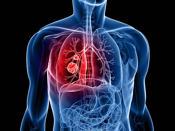 Lung Cancer Diagnostics Market Set for Significant Growth, Driven by Advancements in Diagnostic Technologies